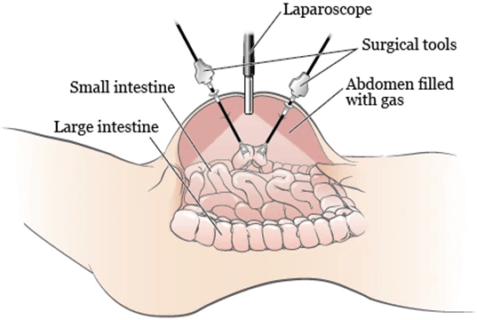 Best Laparoscopic surgeon in pune